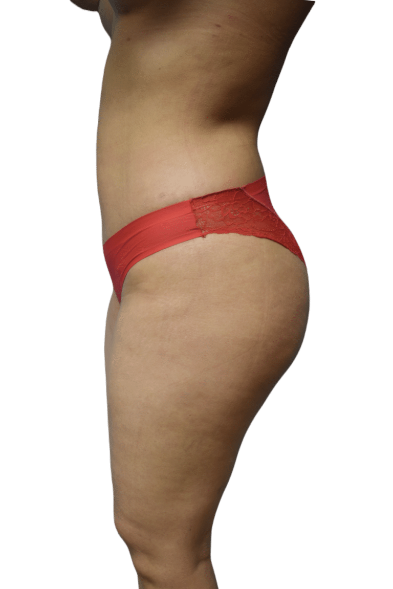 After Image: Brazilian Butt Lift - left-side