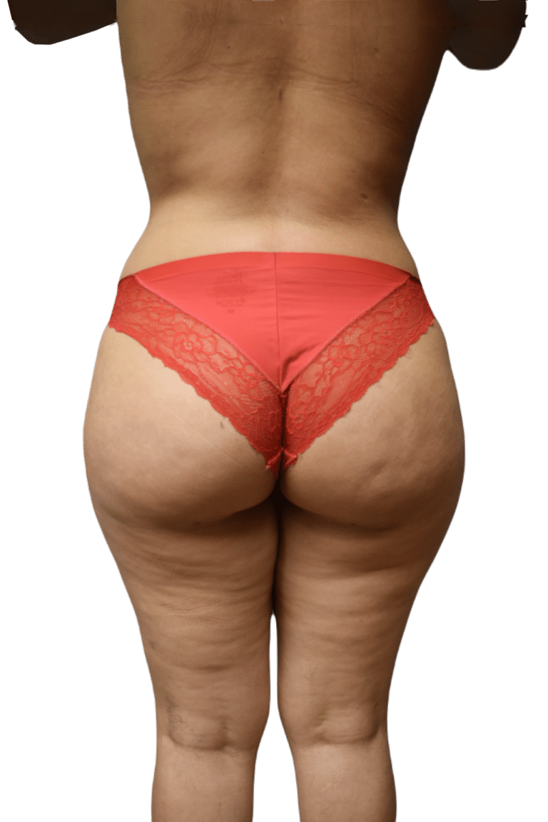 After Image: Brazilian Butt Lift - front