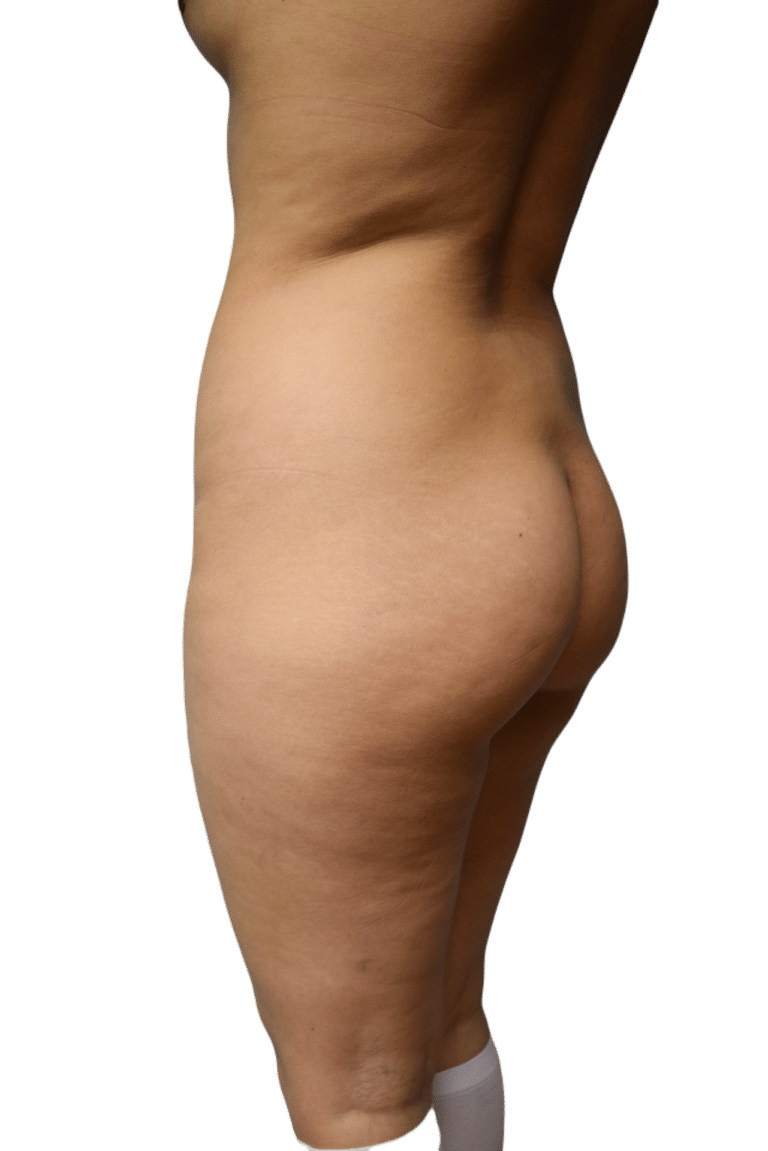 Before Image: Brazilian Butt Lift - left-back-oblique