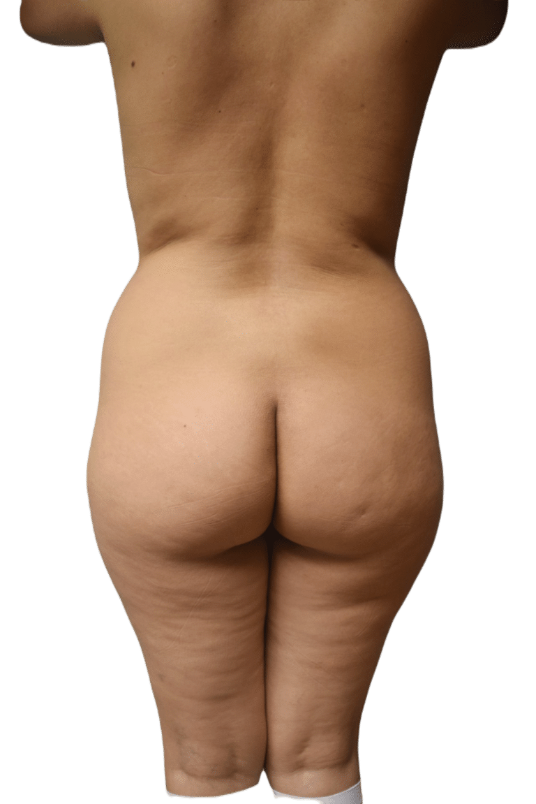 Before Image: Brazilian Butt Lift - front
