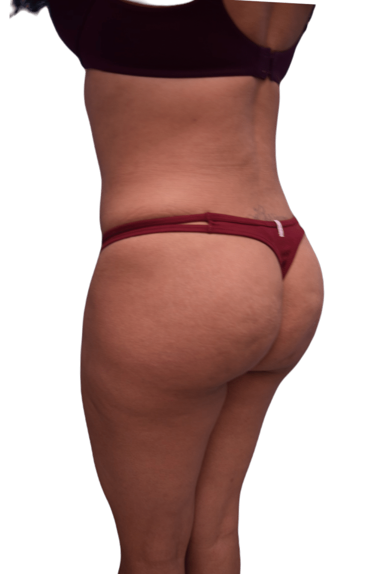 After Image: Brazilian Butt Lift - left-back-oblique