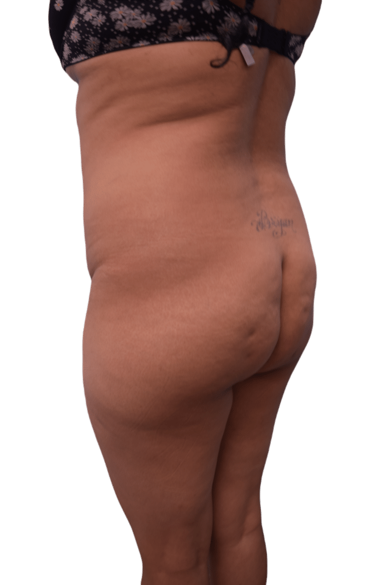 Before Image: Brazilian Butt Lift - left-back-oblique