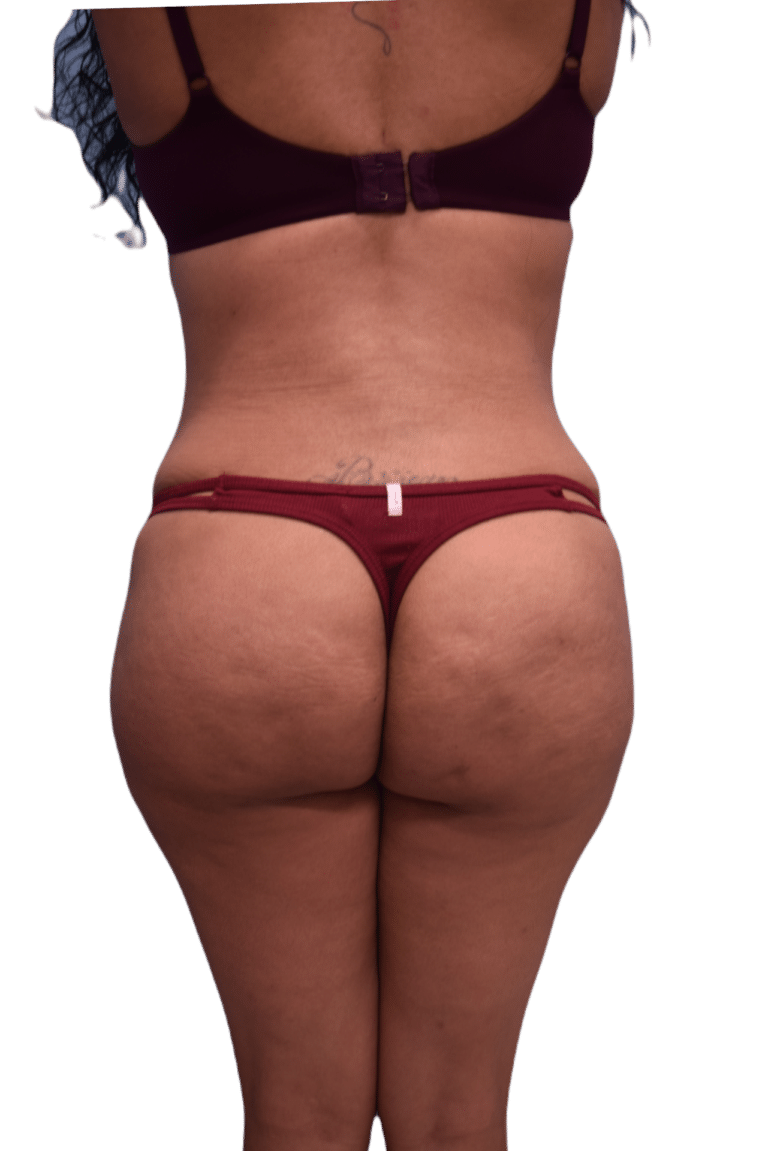After Image: Brazilian Butt Lift - back