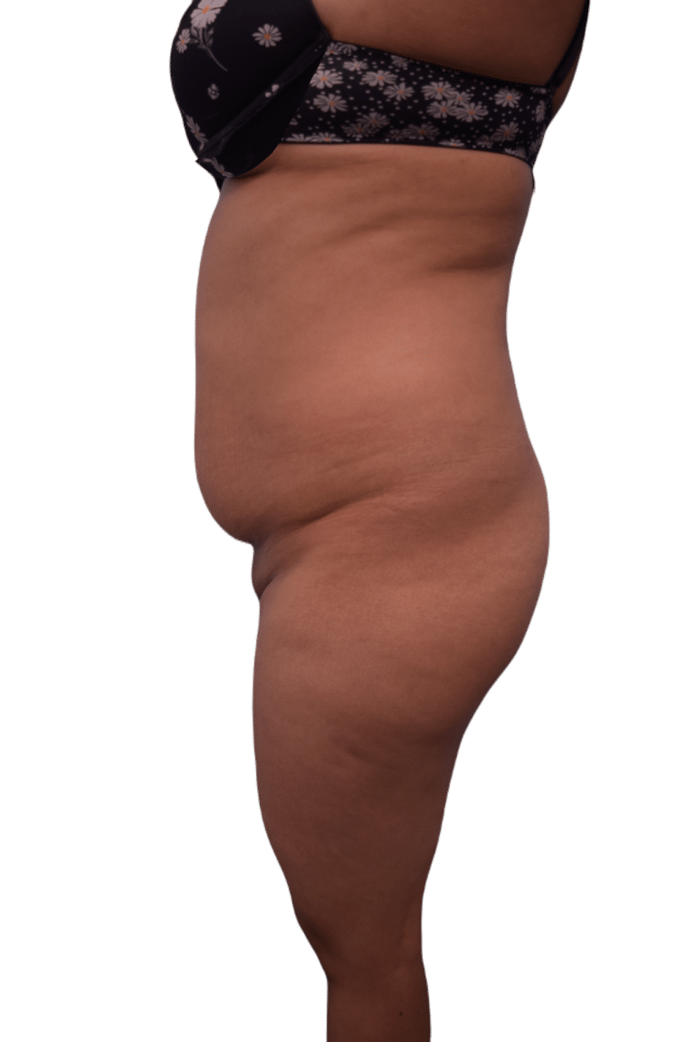 Before Image: Brazilian Butt Lift - left-side