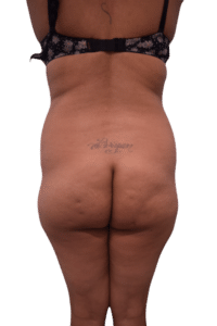 Before Image: Brazilian Butt Lift