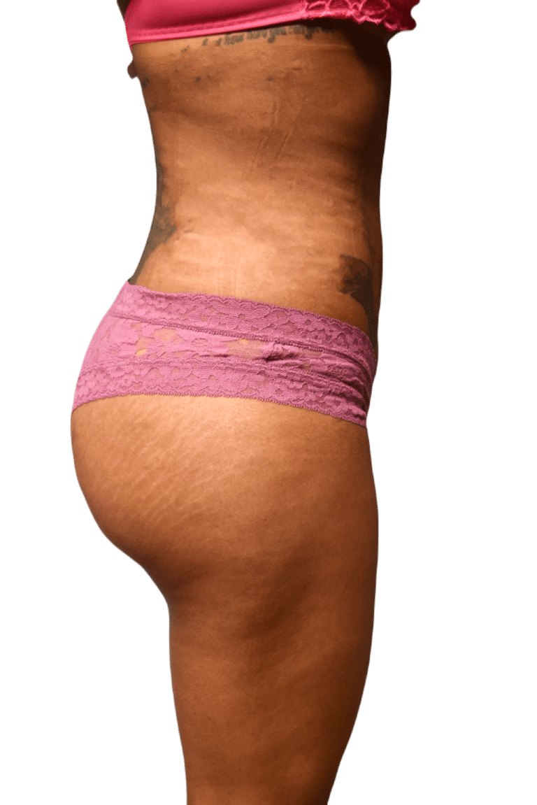 After Image: Brazilian Butt Lift -