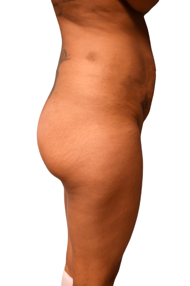 Before Image: Brazilian Butt Lift -