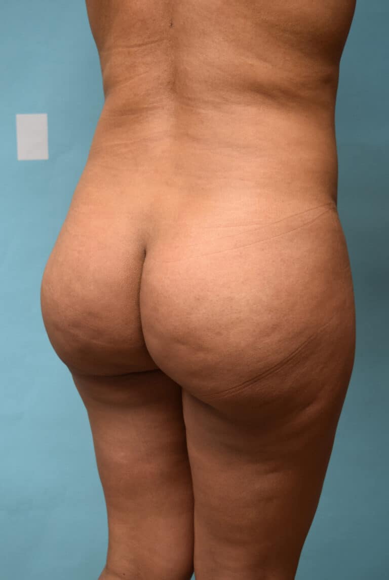 After Image: Brazilian Butt Lift - right-back-oblique