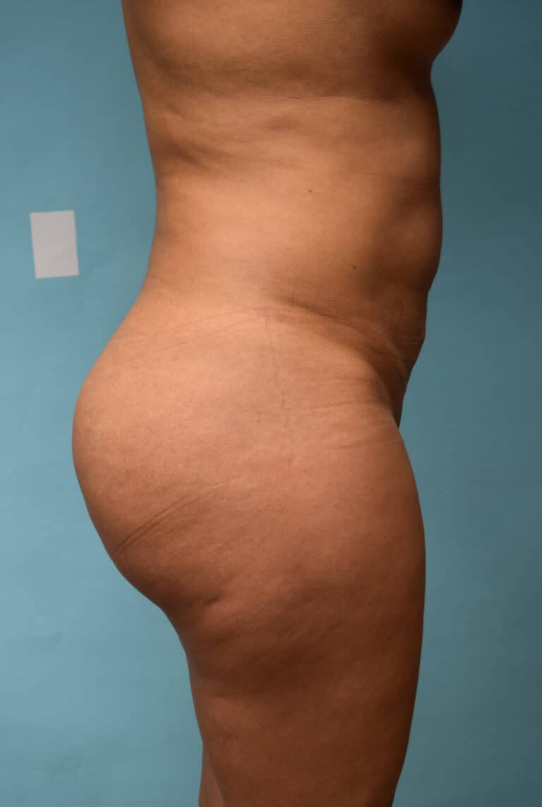 After Image: Brazilian Butt Lift - right-side