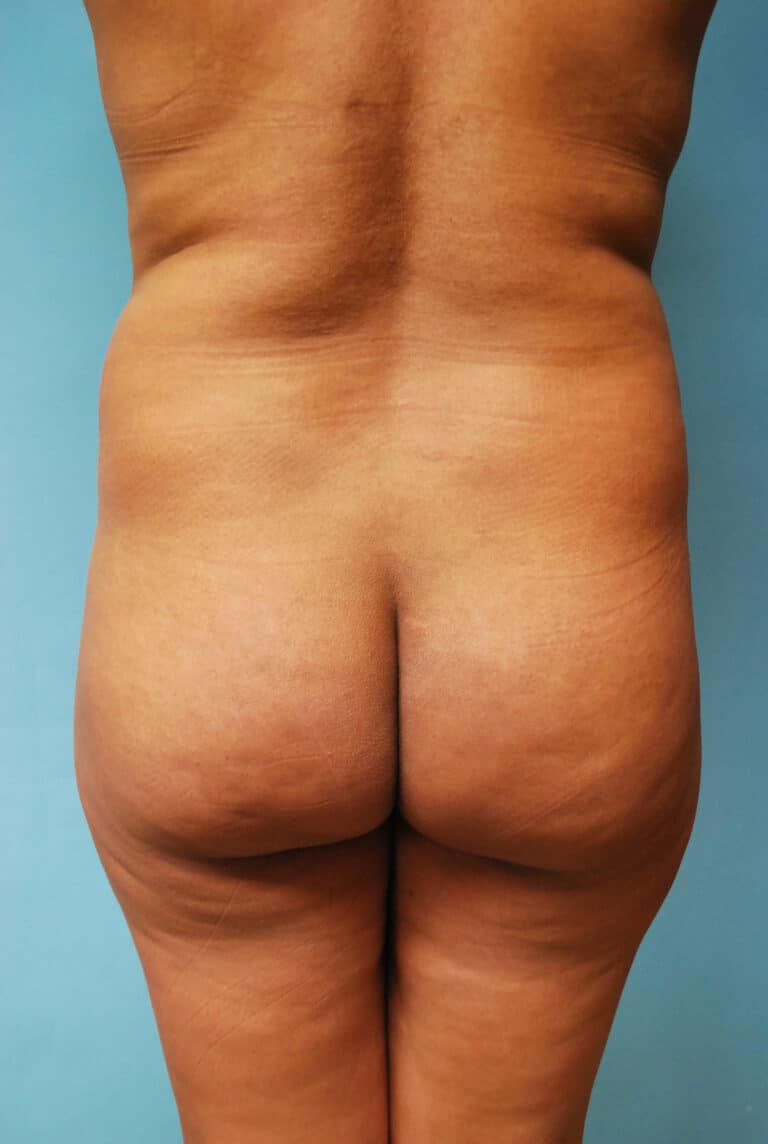 Before Image: Brazilian Butt Lift - back