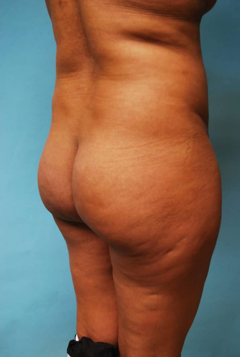 Before Image: Brazilian Butt Lift - right-back-oblique