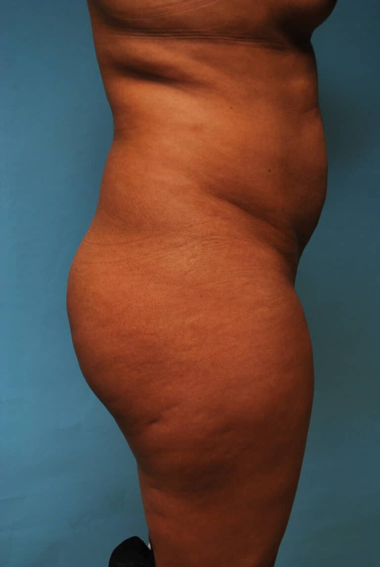 Before Image: Brazilian Butt Lift - right-side