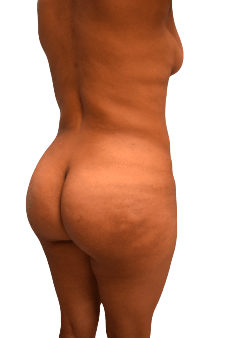 After Image: Brazilian Butt Lift - right-back-oblique