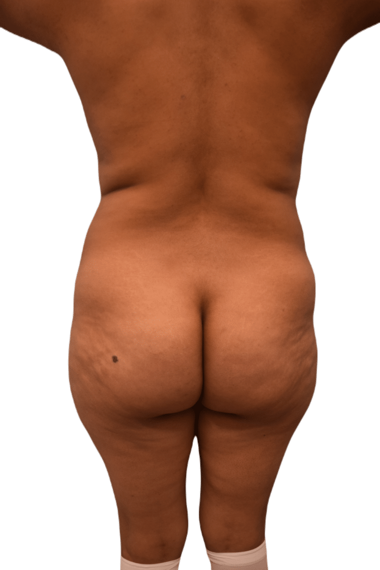 Before Image: Brazilian Butt Lift - back