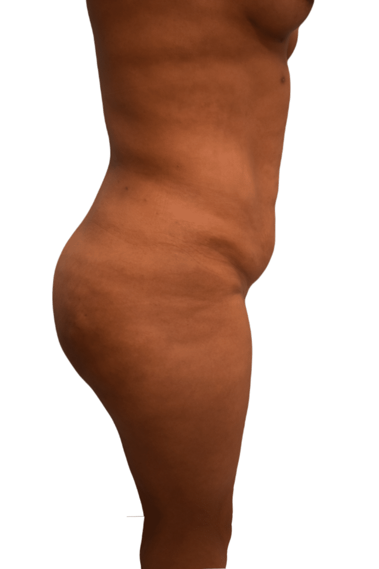 After Image: Brazilian Butt Lift - right-side