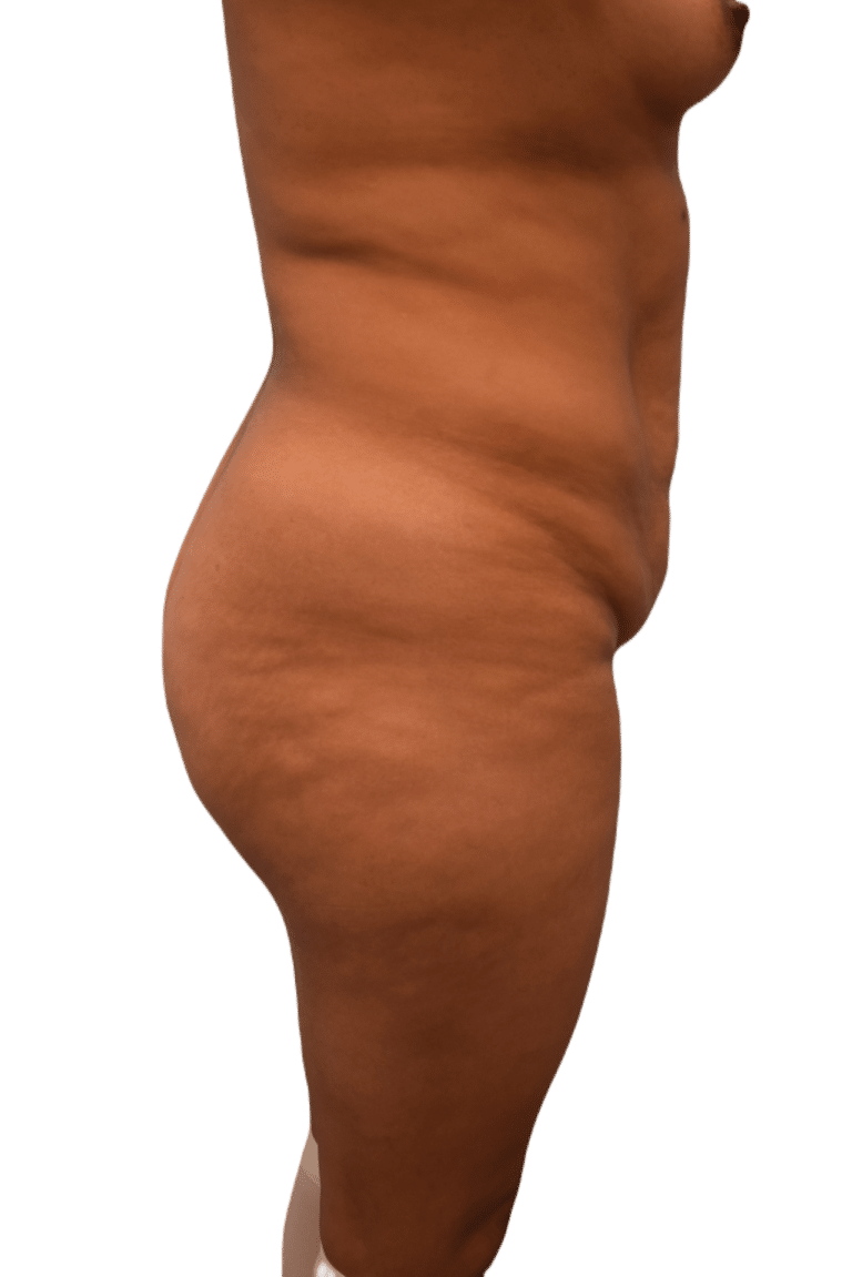 Before Image: Brazilian Butt Lift - right-side