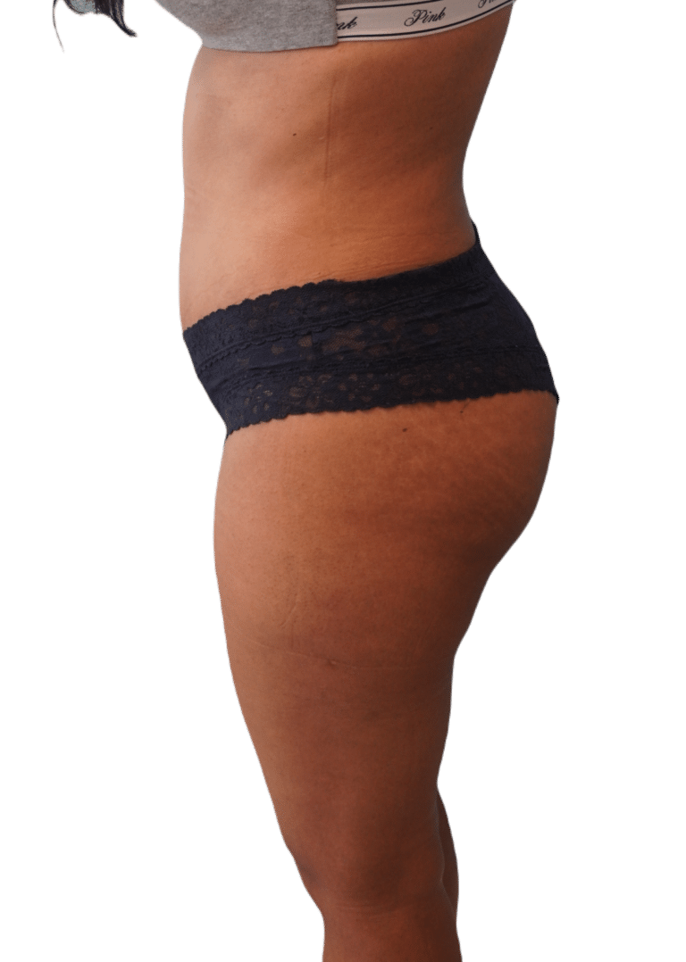 After Image: Brazilian Butt Lift - left-side