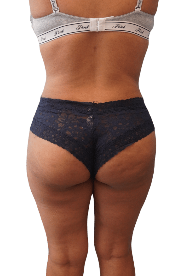 After Image: Brazilian Butt Lift - back