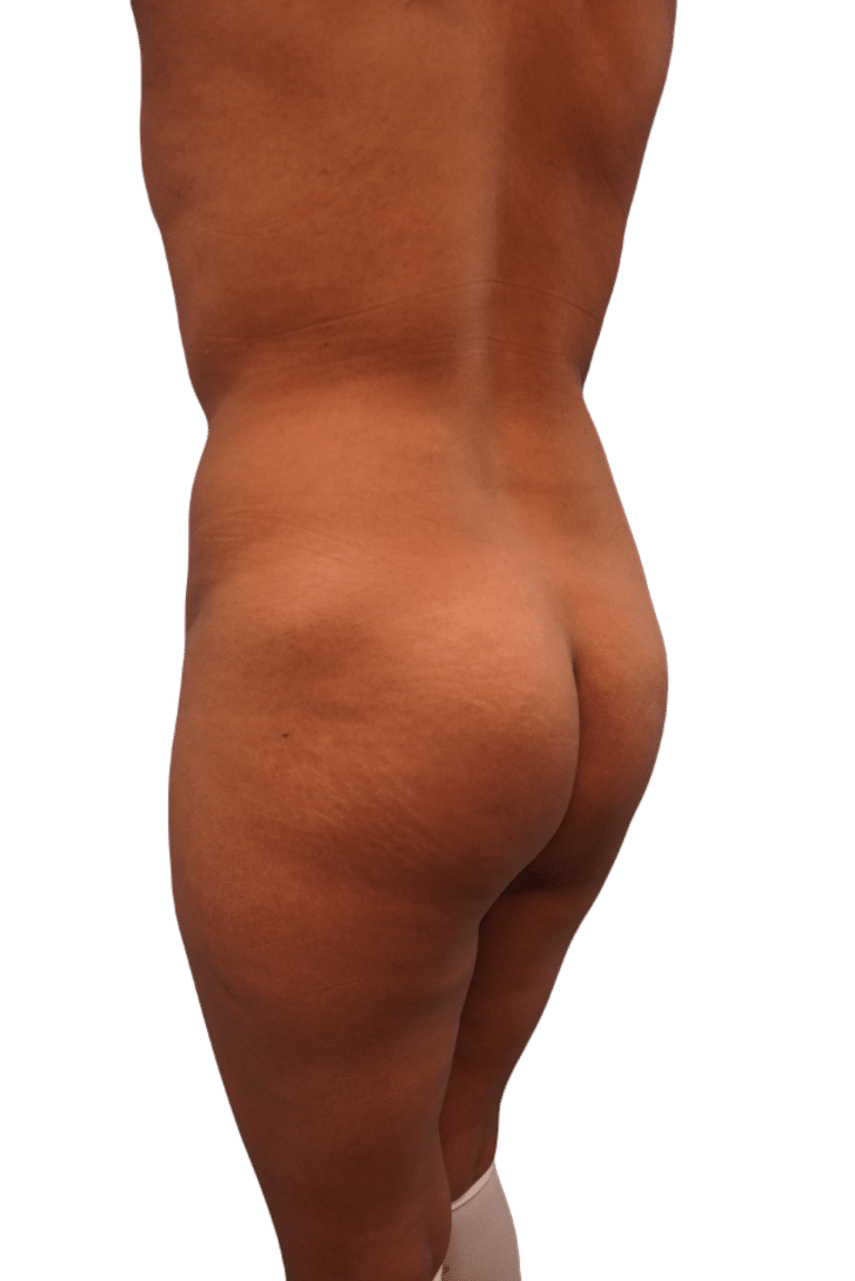 Before Image: Brazilian Butt Lift - left-back-oblique