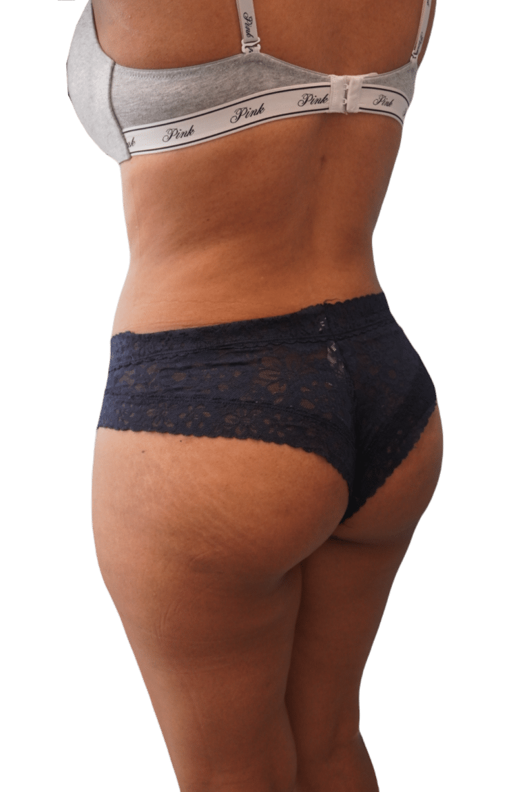 After Image: Brazilian Butt Lift - left-back-oblique