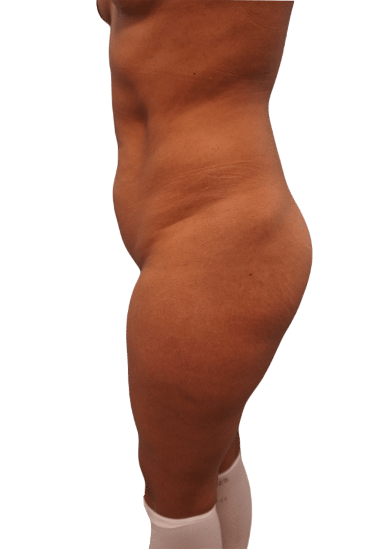 Before Image: Brazilian Butt Lift - left-side