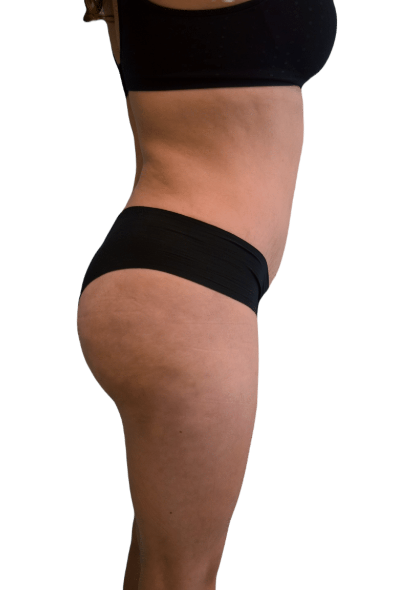 After Image: Brazilian Butt Lift - right-side