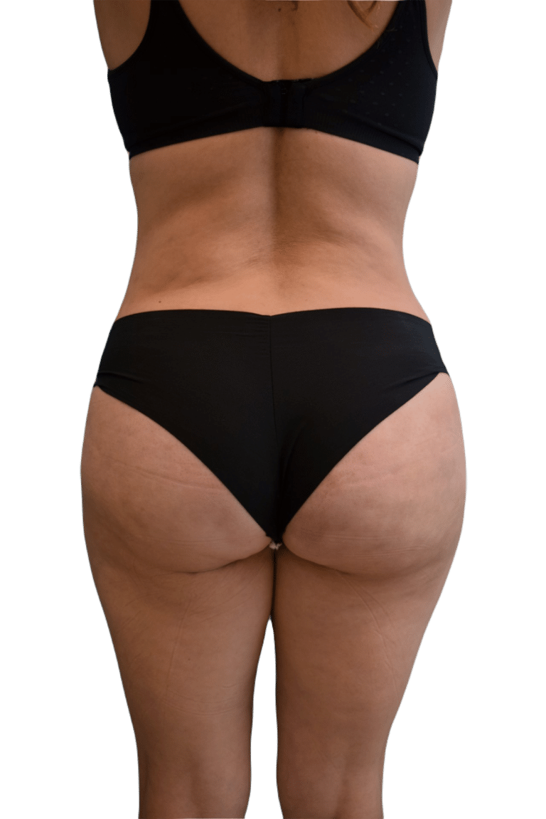 After Image: Brazilian Butt Lift - back