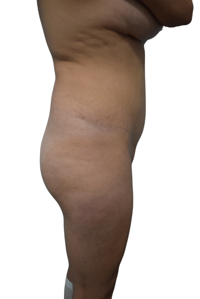 Before Image: Brazilian Butt Lift - right-side