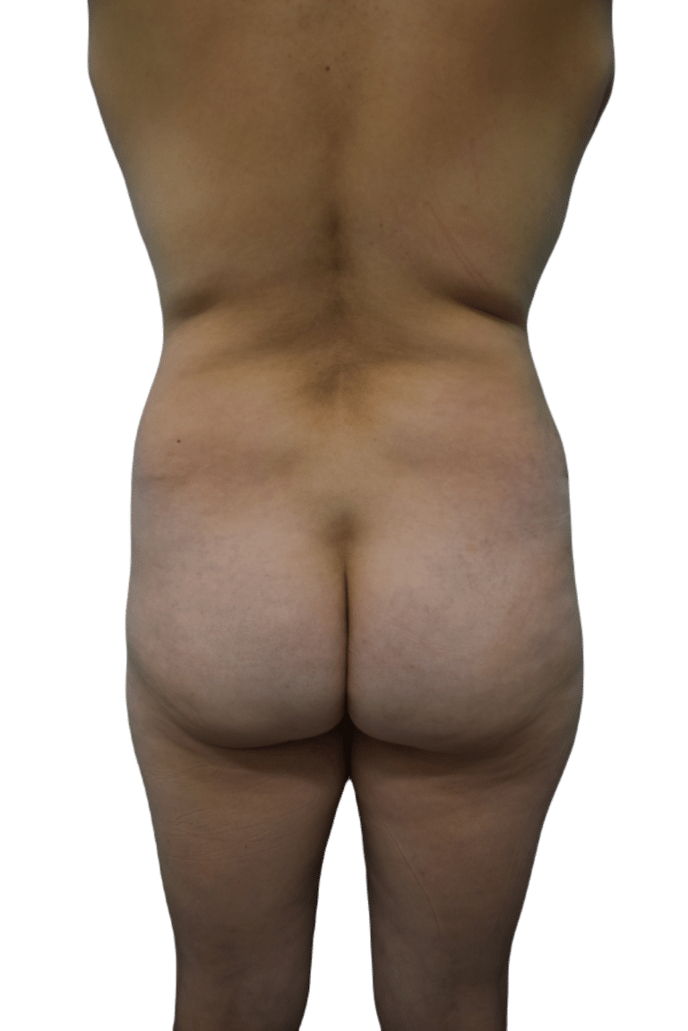 Before Image: Brazilian Butt Lift - back