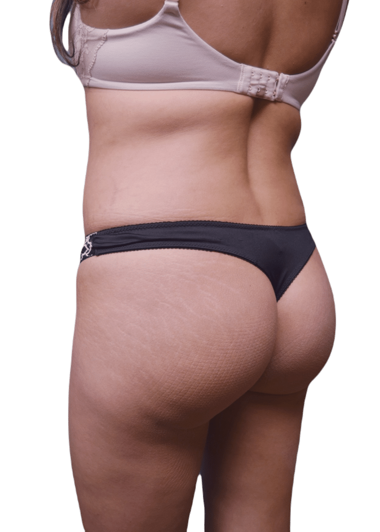 After Image: Brazilian Butt Lift - left-back-oblique