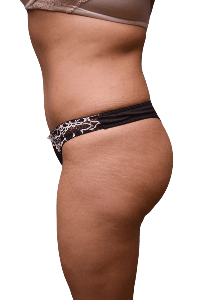 After Image: Brazilian Butt Lift - left-side