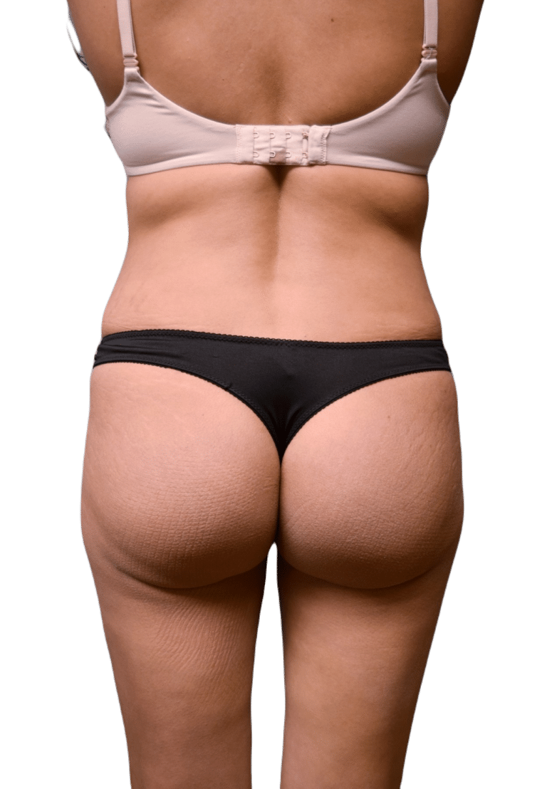 After Image: Brazilian Butt Lift - back