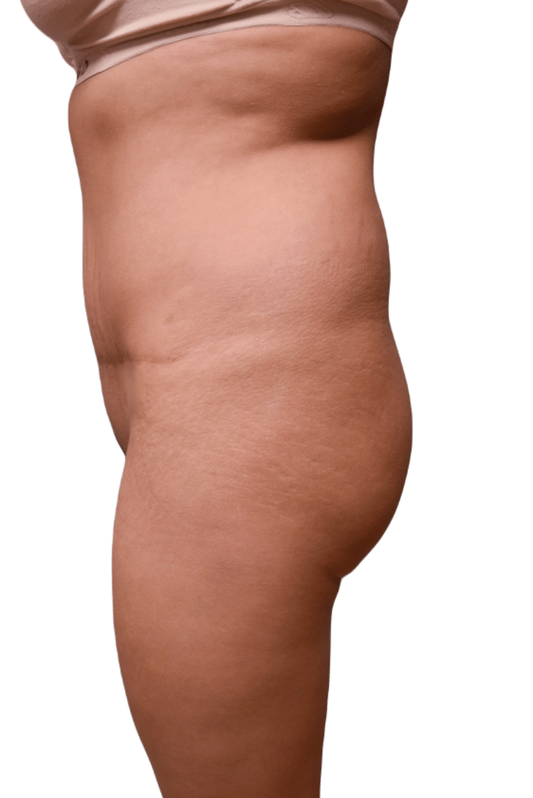 Before Image: Brazilian Butt Lift - left-side