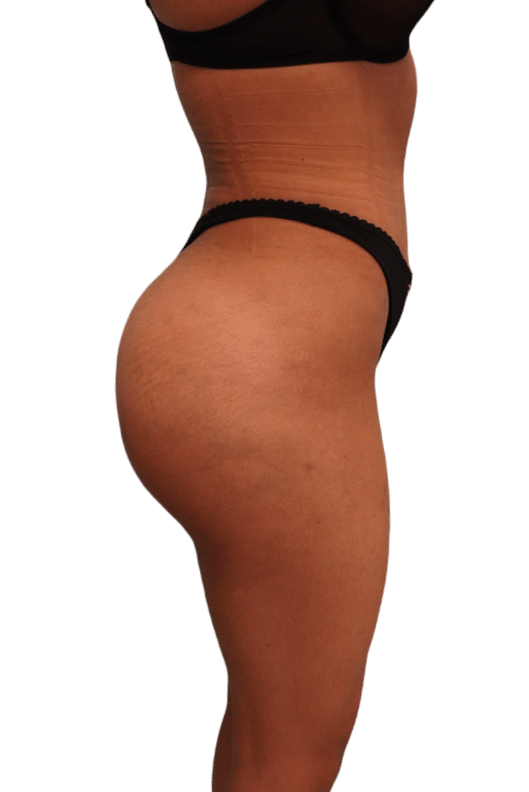 After Image: Brazilian Butt Lift - right-side