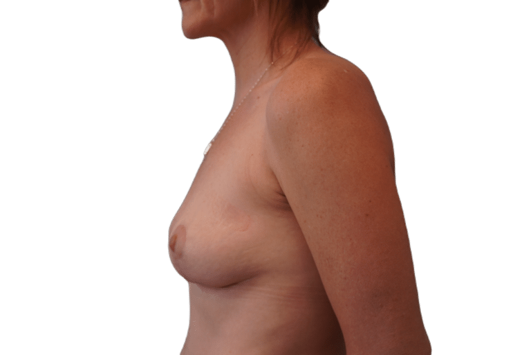 After Image: Breast lift - left-side