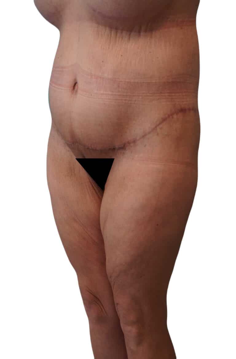 After Image: Body Lift - left-front-oblique