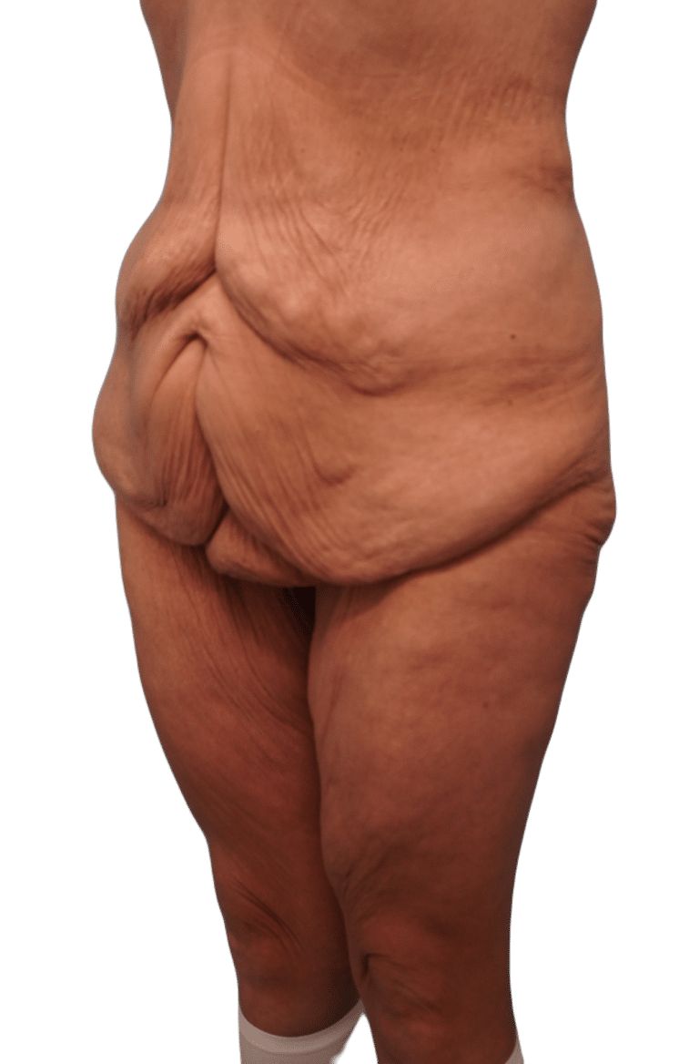 Before Image: Body Lift - left-front-oblique