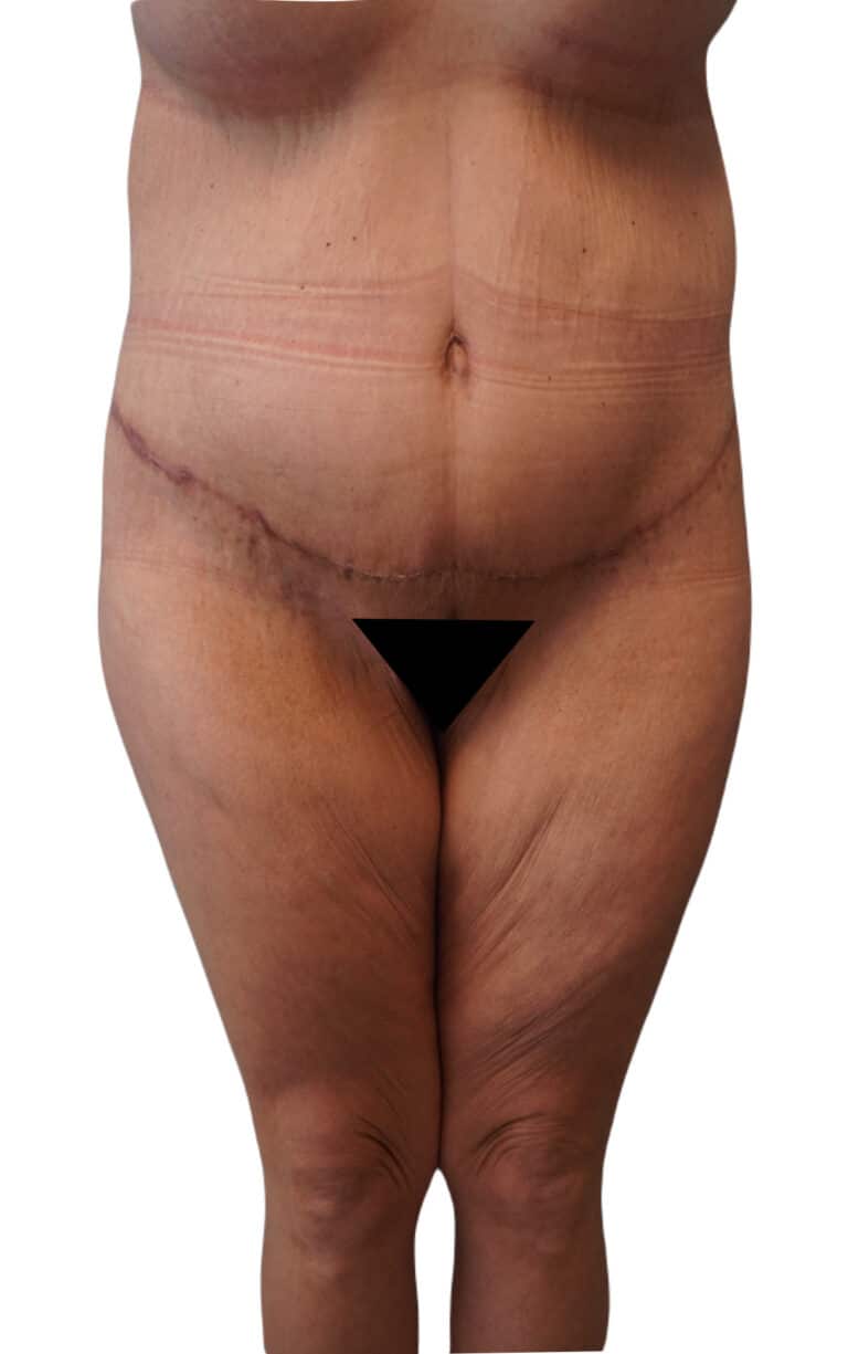After Image: Body Lift - front