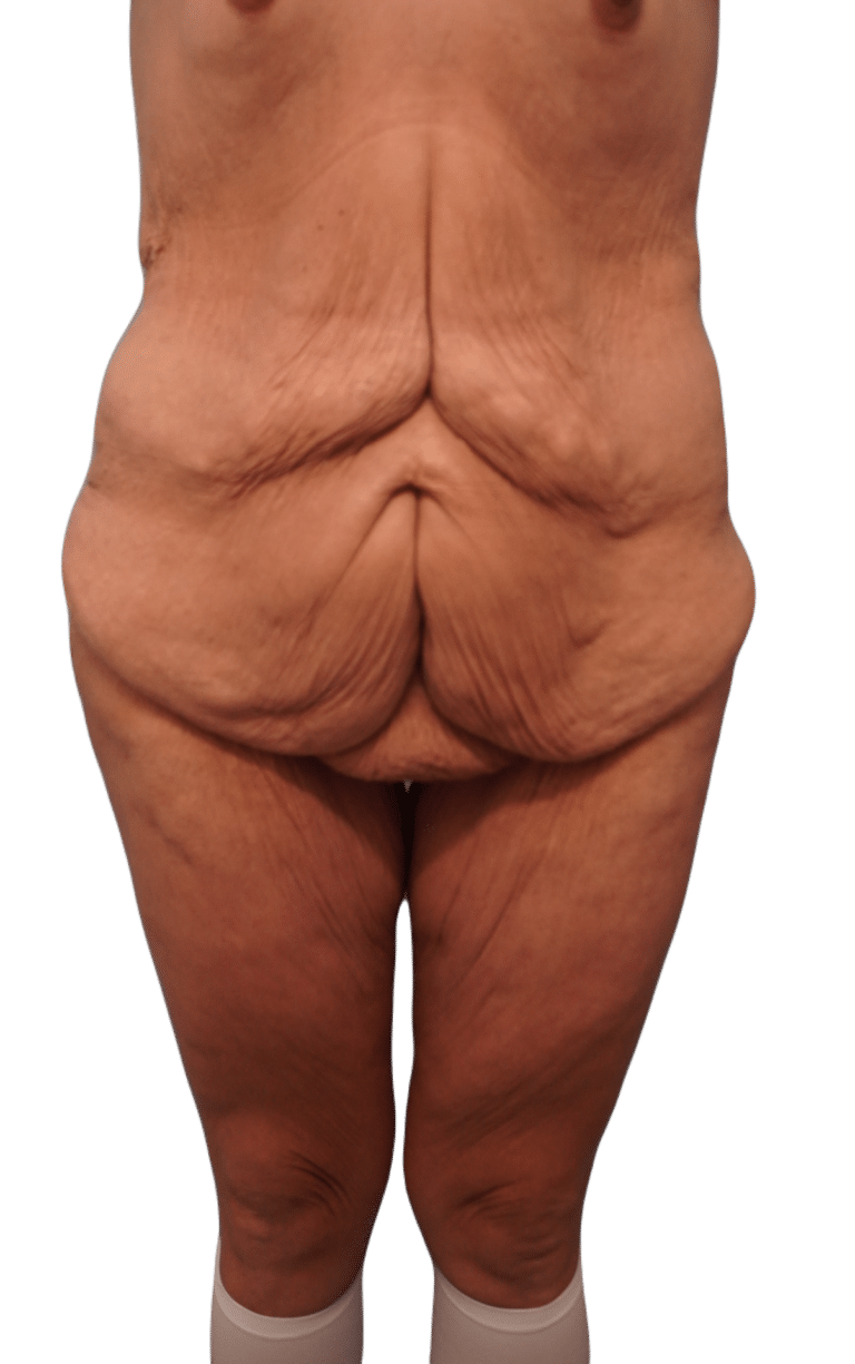 Before Image: Body Lift - front