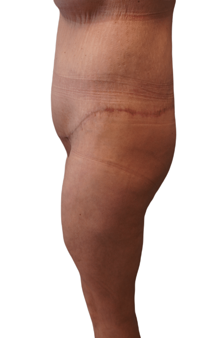 After Image: Body Lift - left-side