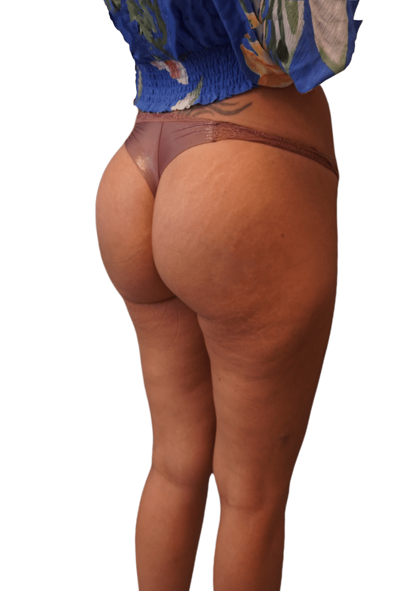 After Image: Butt Implants -