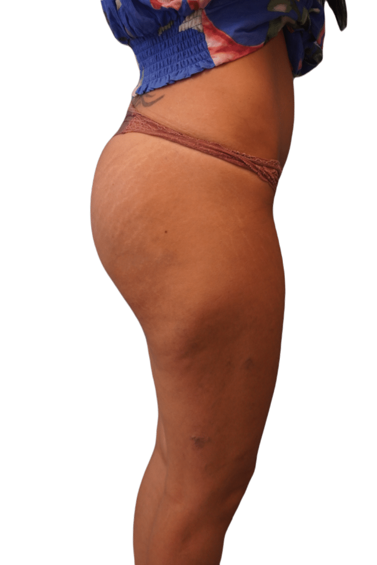 After Image: Butt Implants - right-side