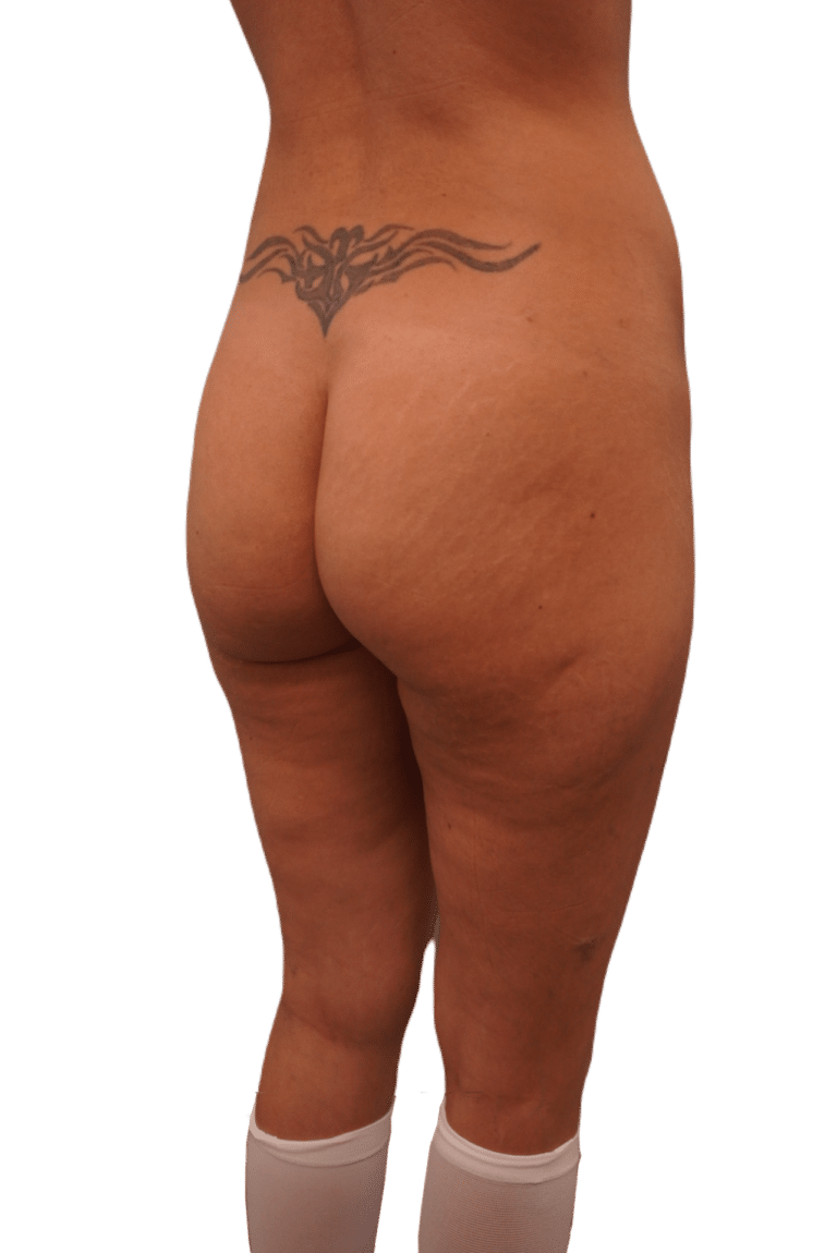 Before Image: Butt Implants -