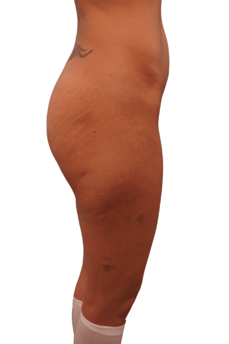 Before Image: Butt Implants - right-side