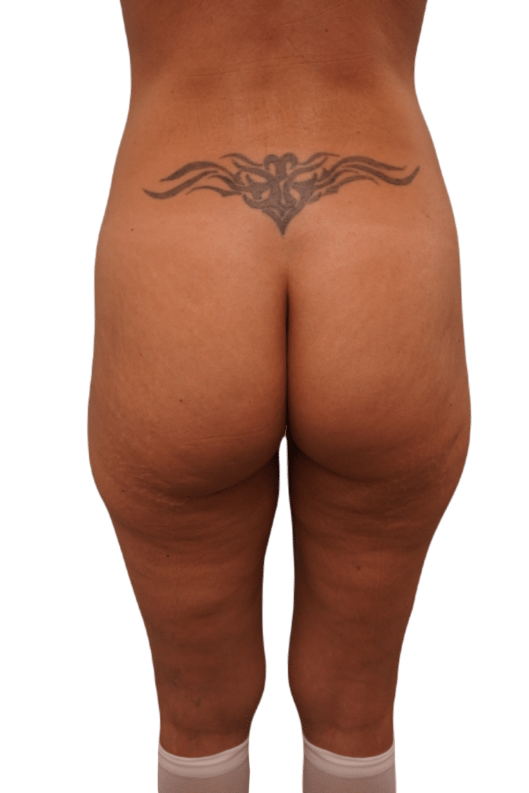 Before Image: Butt Implants -