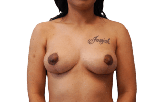 After Image: Breast Implant Removal & Lift