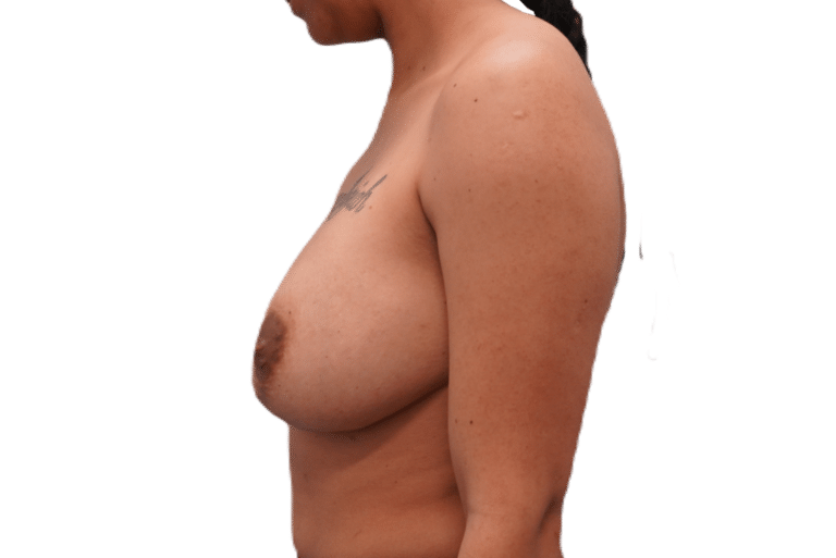 Before Image: Breast Implant Removal & Lift - left-side