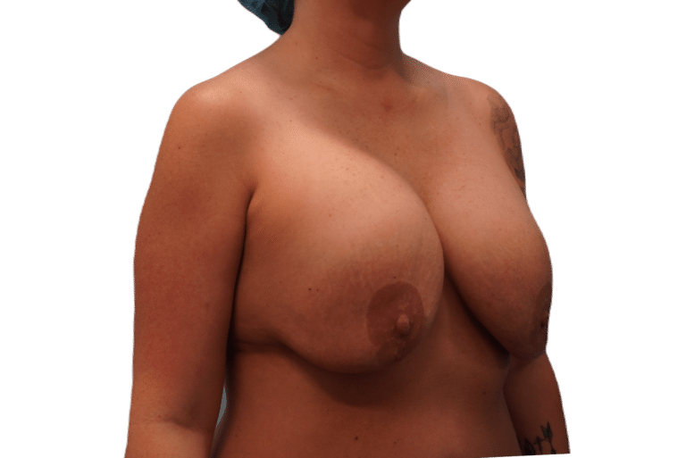 Before Image: Breast Implant Removal & Lift - right-front-oblique