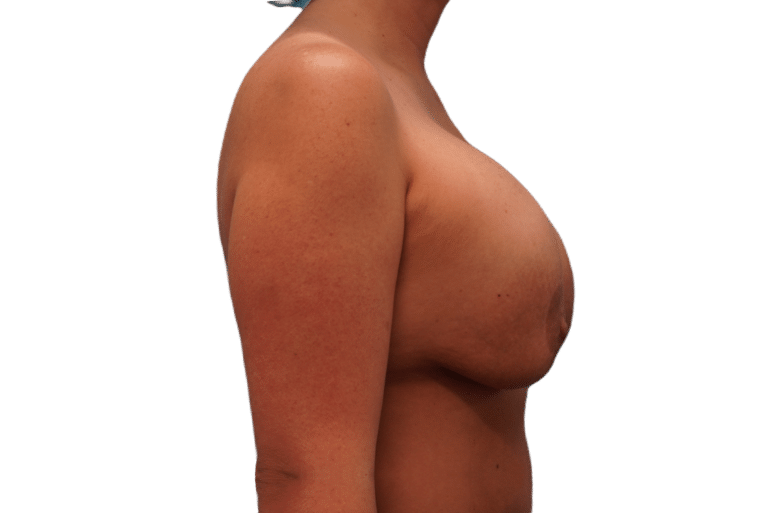 Before Image: Breast Implant Removal & Lift - right-side