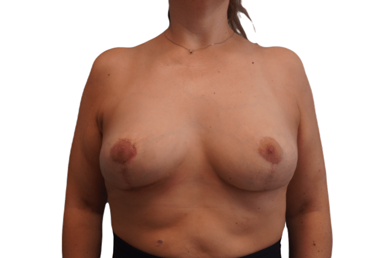 After Image: Breast Implant Removal & Lift - front
